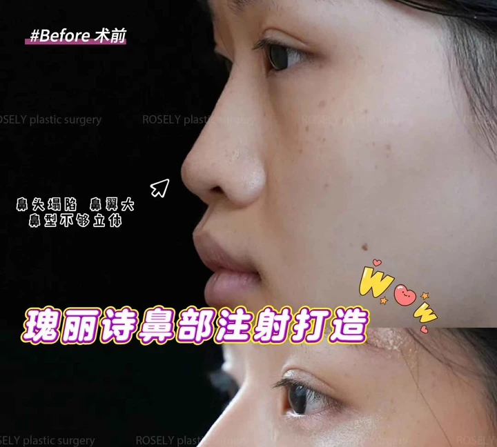 سجل حقن الأنف