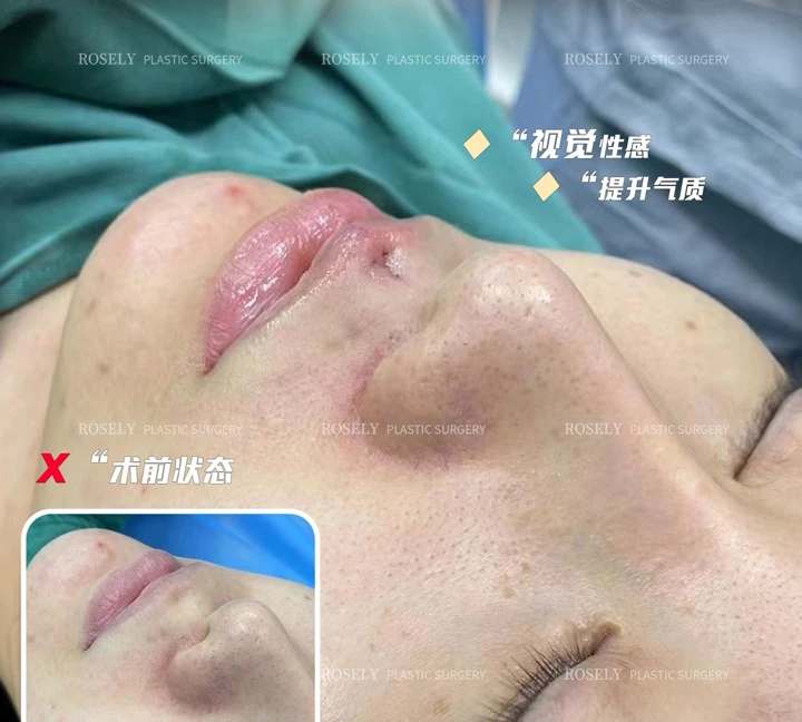 سجل موضعي للنثرة مباشرة