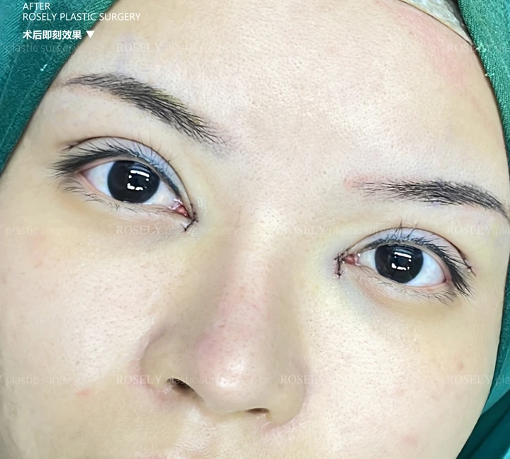 سجل العين مباشرة مع صورة قبل الإجراء