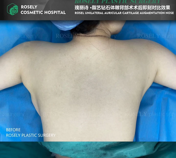 Back contouring
