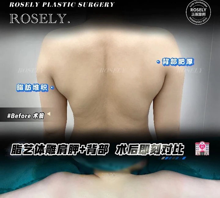 Back & waist contouring
