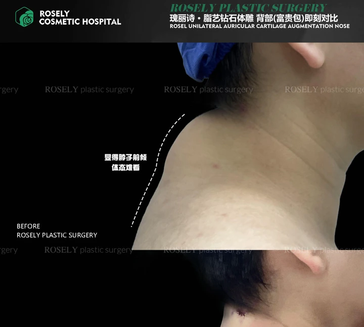 Upper-back contouring