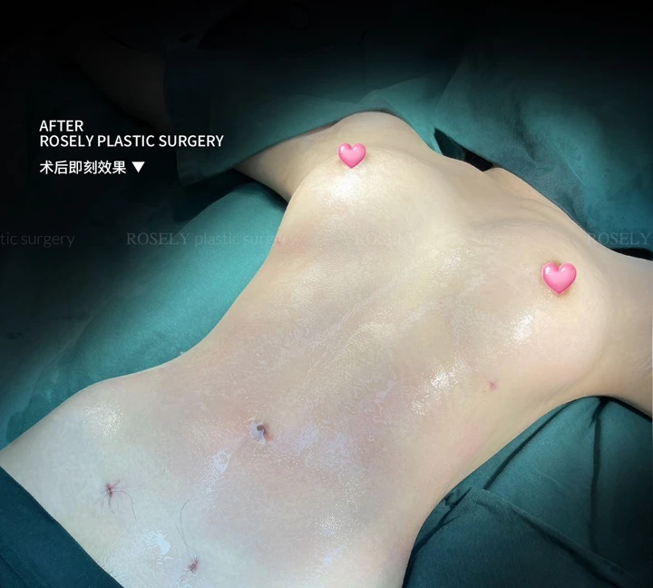 Waist contouring & breast fat procedures