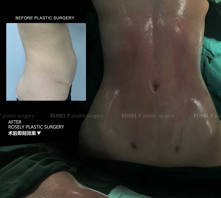 Waist & abdominal contouring