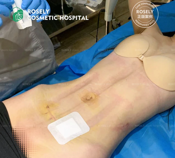 Waist & abdominal contouring